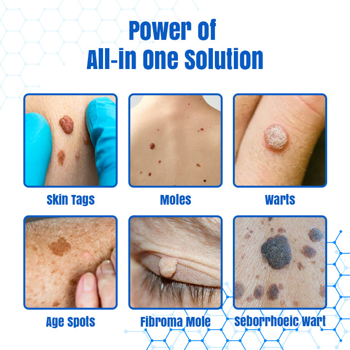 Bikenda® DermZap Mole & Wart Removal Laser Pen