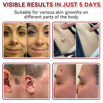 🔥 2025 New Formula ⚡Cvreoz® Microneedle Skin Tag Removal Patches – Visible Results in 5 Days