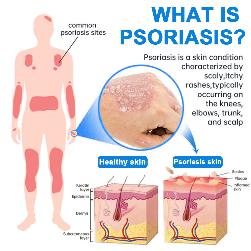 ✅ Official Store: Cvreoz® Magnesium Herbal Psoriasis & Eczema – Fast-Acting, Steroid-Free Relief