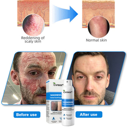 ✅ Official Store: Cvreoz® Magnesium Herbal Psoriasis & Eczema – Fast-Acting, Steroid-Free Relief
