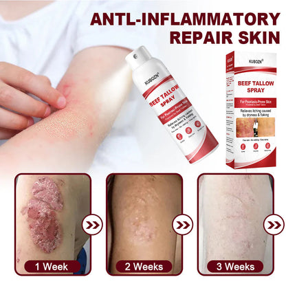 KUBOZN® Beef Tallow Spray — The No-Rub Relief for Psoriasis-Prone Skin✨ (Offer)