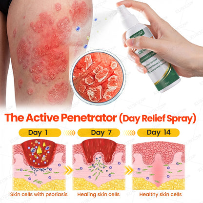 KUBOZN® Psoriasis Day & Night Repair System - 100% Steroid-Free Relief Duo for Plaques, Scaling & Itch (offer)