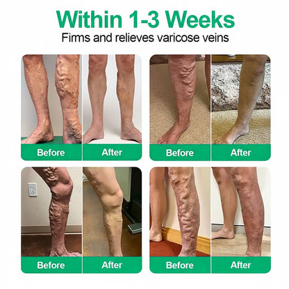 👨‍⚕️🔥Healrize® VeinEase Microneedle Care Patch⚡Instant Relief, Long-Term Results