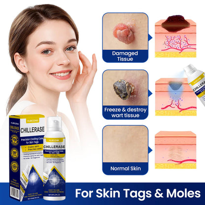 KUBOZN® ChillErase Cooling Spray for Skin Tags
